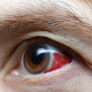 Uveítes e Doenças Oculares Inflamatórias